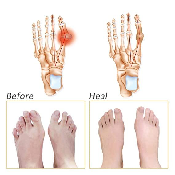 Soft Silicon Gel Half Toe Sleeve Forefoot Pads For Pain Relief